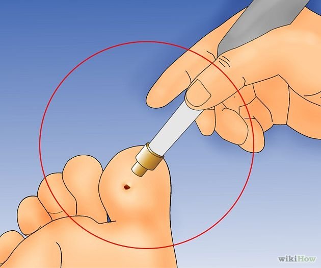 Get Rid of Plantar Warts Step 5.jpg