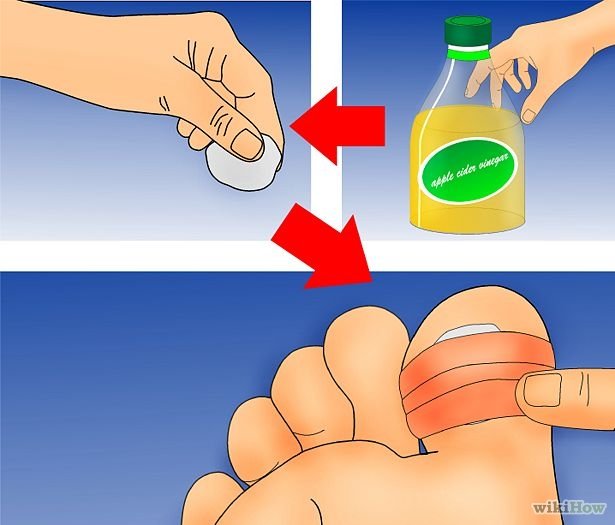 Get Rid of Plantar Warts Step 3Bullet4.jpg