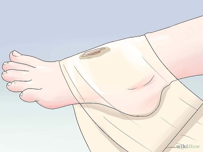 Get Rid of a Scab Step 3.jpg