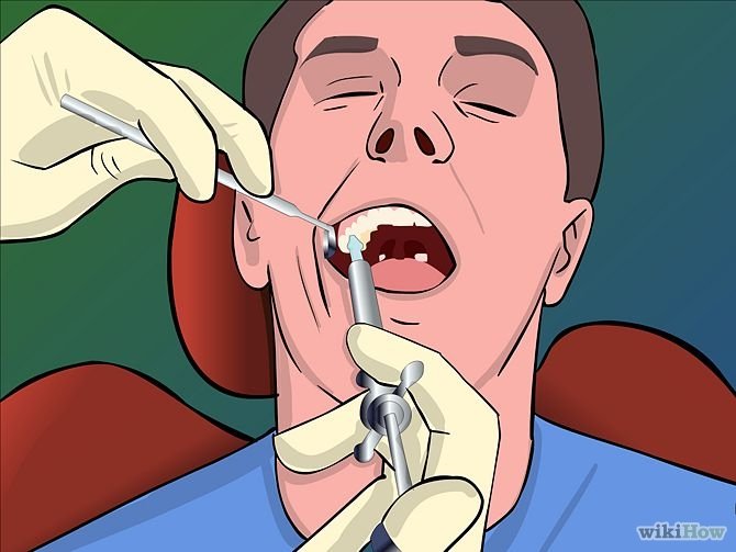 Image titled Remove Tonsil Stones (Tonsiliths) Step 18