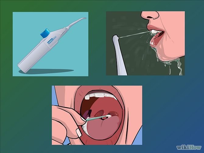 Image titled Remove Tonsil Stones (Tonsiliths) Step 12