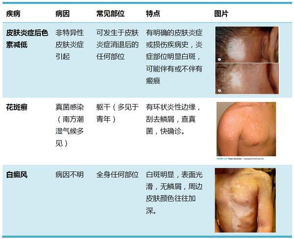 孩子臉上「白斑」，是肚子裡有蟲麼？