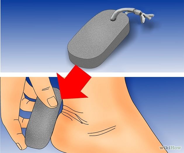 Get Rid of Plantar Warts Step 1Bullet2.jpg