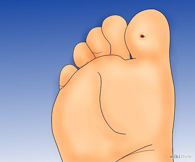 Get Rid of Plantar Warts Step 1Bullet6.jpg