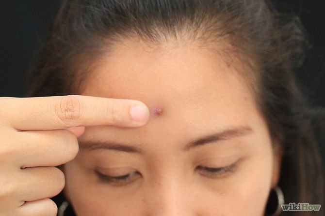 Pop a Pimple Step 1.jpg