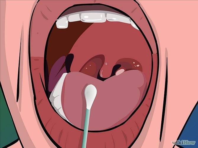 Image titled Remove Tonsil Stones (Tonsiliths) Step 4