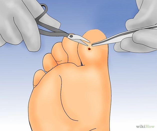 Get Rid of Plantar Warts Step 10.jpg