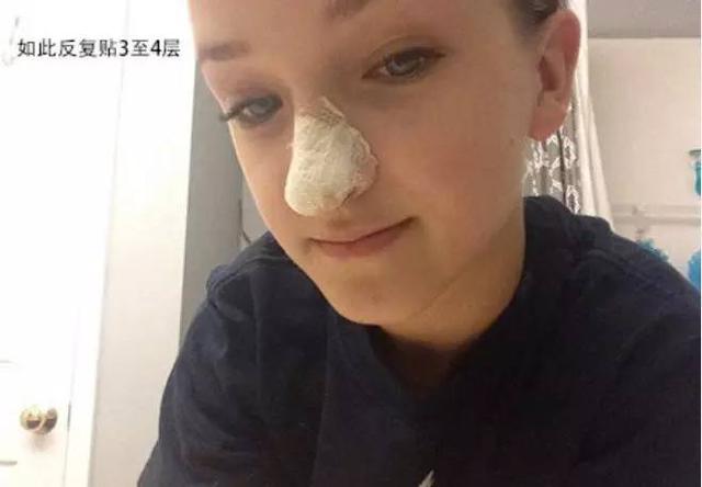 去黑頭舊招新用，親測有效