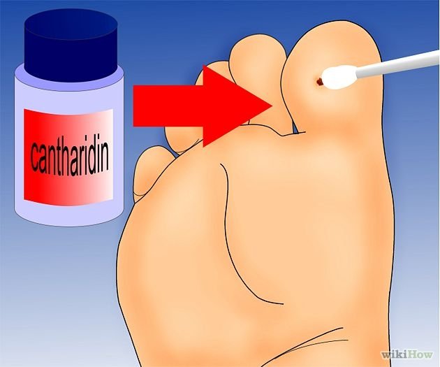 Get Rid of Plantar Warts Step 6.jpg