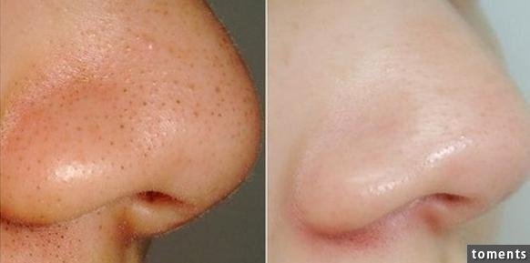 4大招讓黑頭永遠消失!毛孔變小了!粉刺痘痘通通不見了!太棒了一定要學起來!