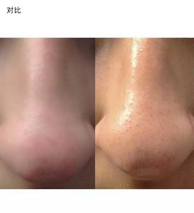 去黑頭舊招新用，親測有效