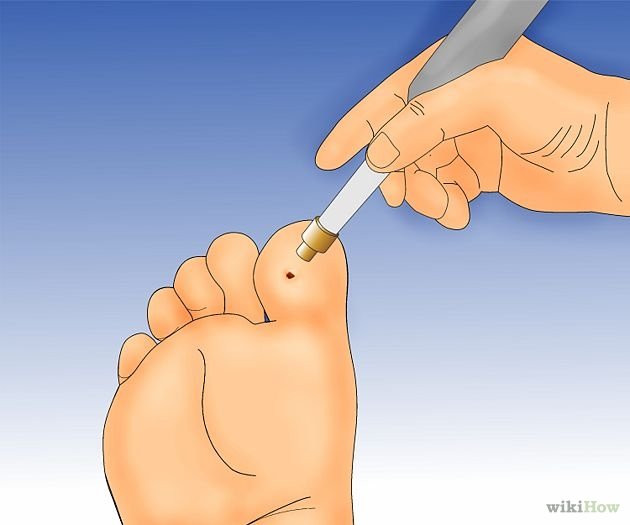 Get Rid of Plantar Warts Step 2.jpg