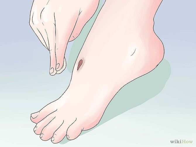 Get Rid of a Scab Step 15.jpg