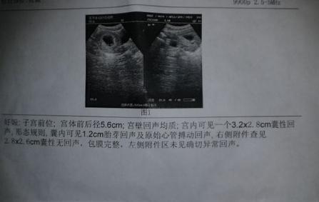 孕婦臨產前超音波檢查還是雙胞胎，就在寶寶出生後讓她瞬間變了臉色
