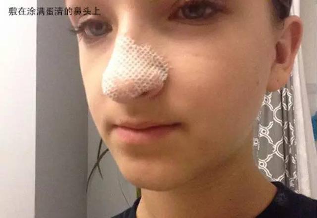 去黑頭舊招新用，親測有效