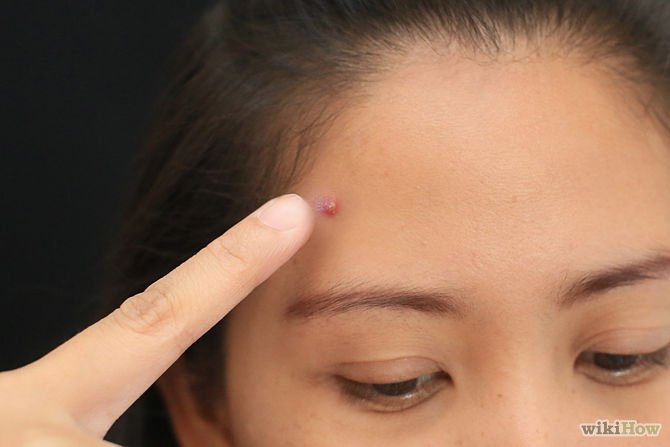 Pop a Pimple Step 2.jpg