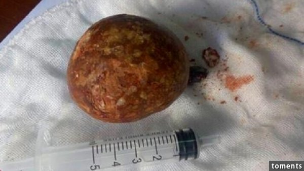 這顆可不是茶葉蛋，而是巨型的膀胱结石，光長度就超過5公分，醫師研判，形成至少要30年以上，提醒民眾多喝水，避免結石上身。（翻攝紅網）