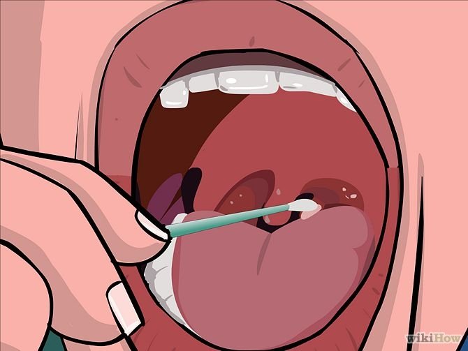 Image titled Remove Tonsil Stones (Tonsiliths) Step 11