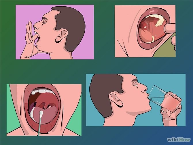 Image titled Remove Tonsil Stones (Tonsiliths) Step 8