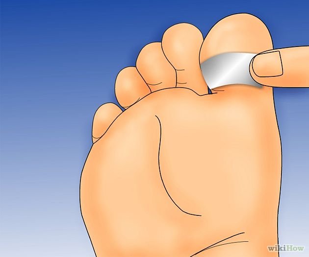 Get Rid of Plantar Warts Step 1Bullet4.jpg