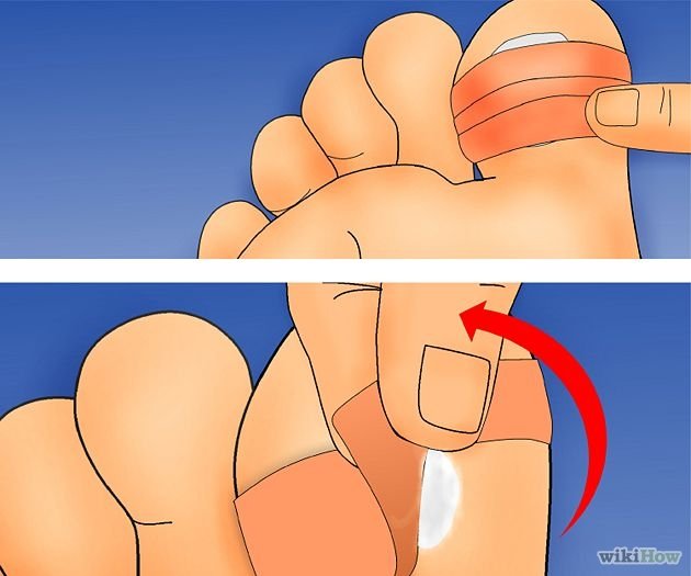 Get Rid of Plantar Warts Step 3Bullet5.jpg