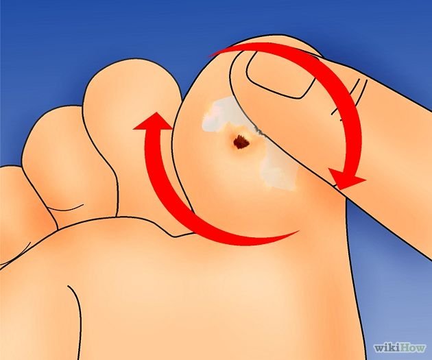 Get Rid of Plantar Warts Step 3Bullet3.jpg