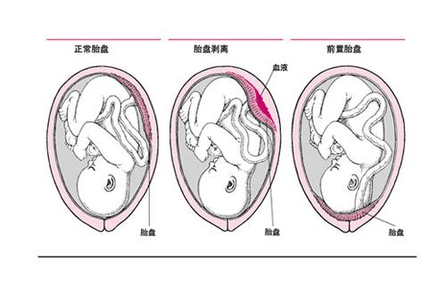 產婦生子 卻被溝通要切除子宮 家人的話更是讓人心寒