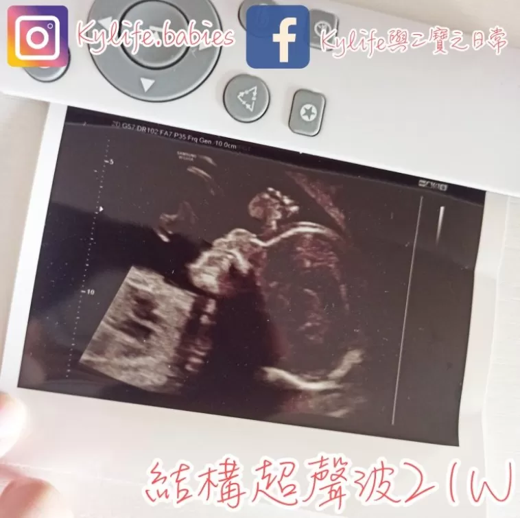 【媽咪二次懷孕21W】中期結構超聲波！話你知有咩要注意啦！